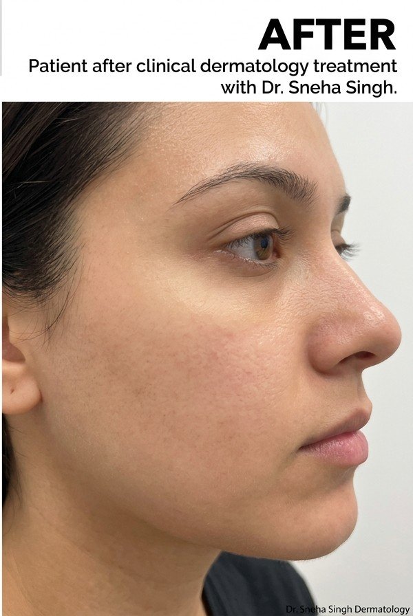 Acne Treatment Result