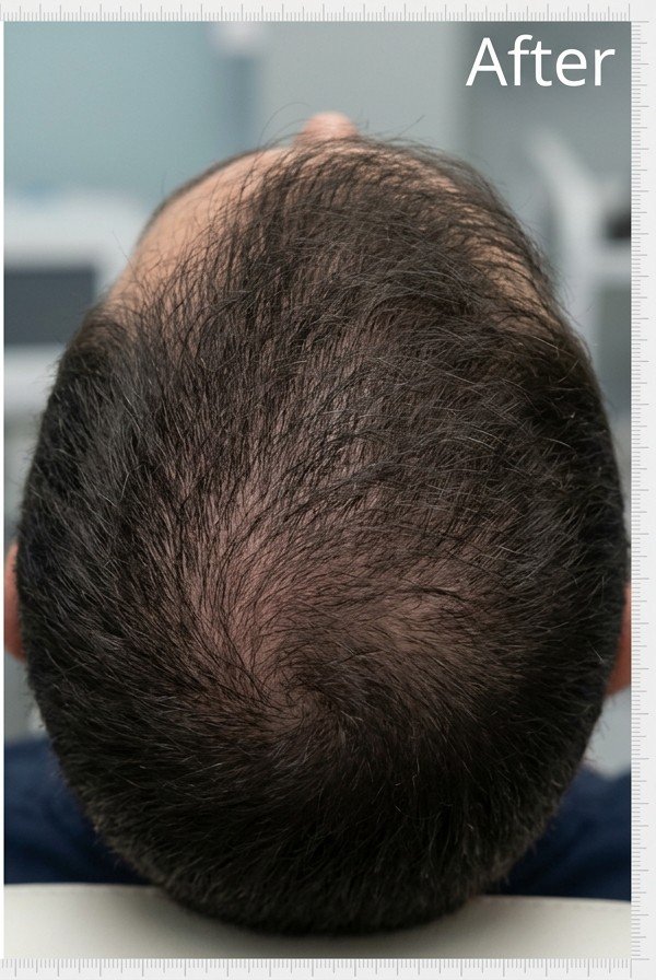 Hair Regrowth Result