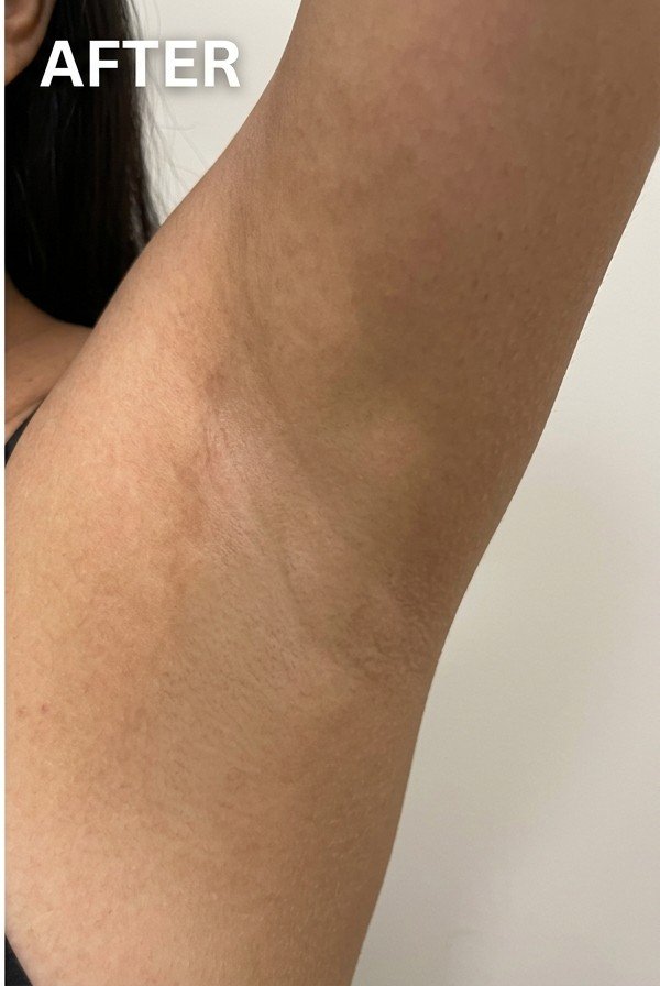 After treatment result at CliniKimaya+