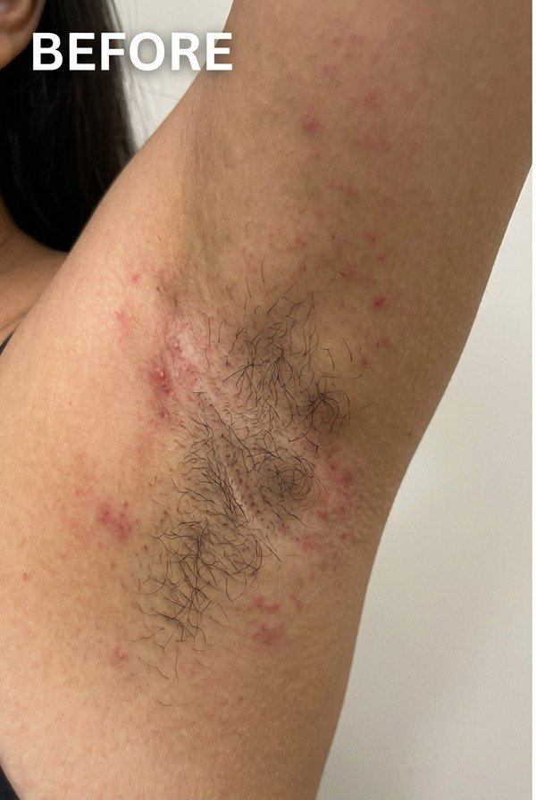 Before treatment baseline at CliniKimaya+